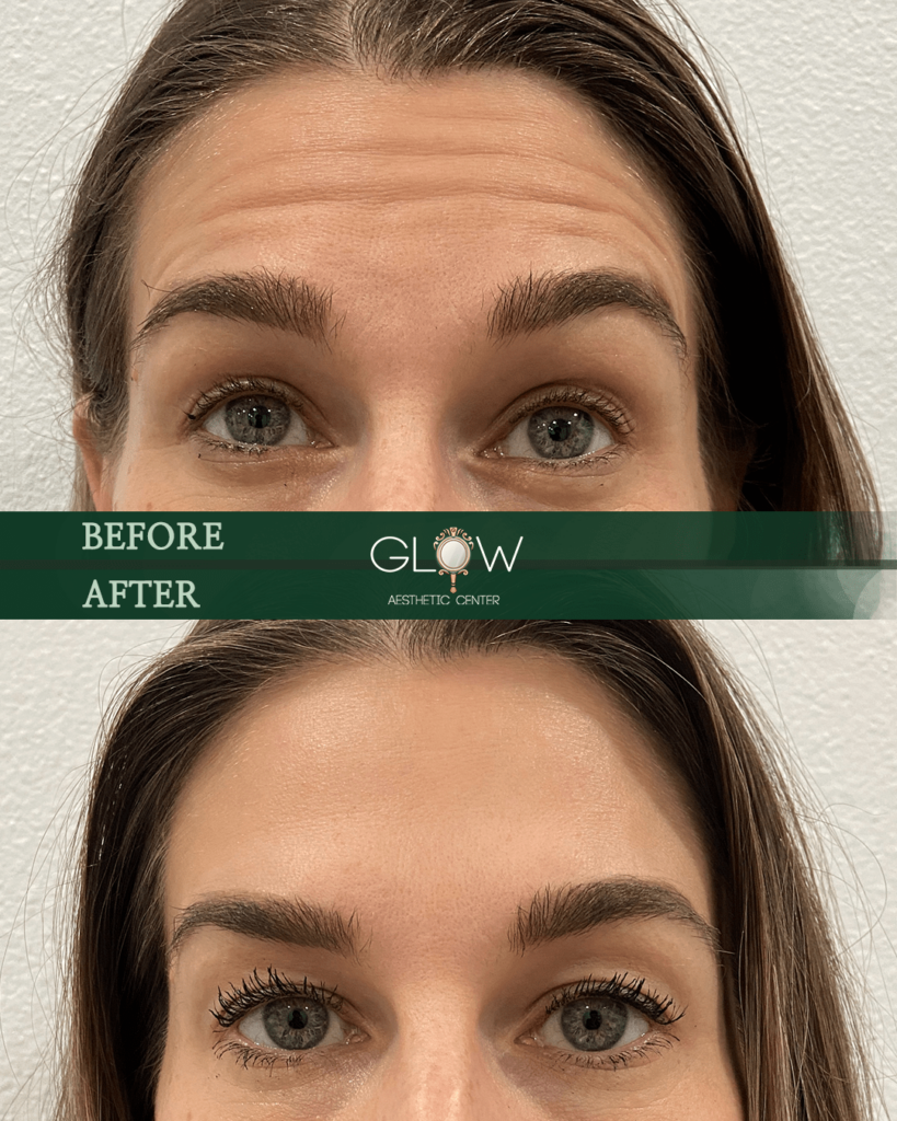 Before and after image showcasing the results of an aesthetic treatment at Glow Aesthetic Center, highlighting improved eyelash length and overall eye appearance.
