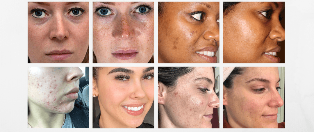 Before and after skincare results showcasing diverse individuals with various skin conditions, including acne, freckles, and hyperpigmentation. The images highlight improvements in skin texture and tone across different skin types.