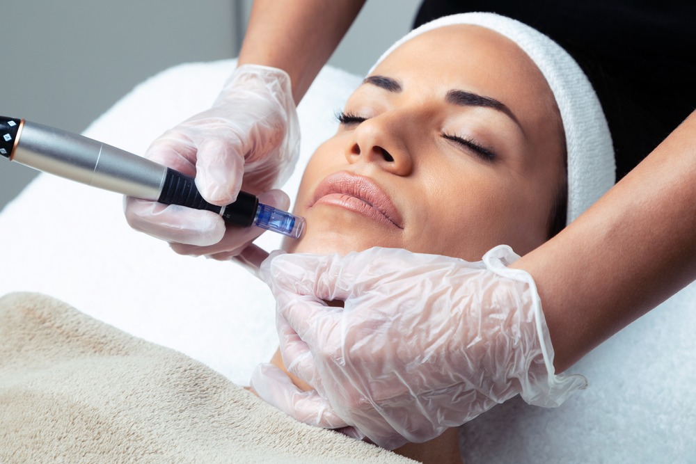 Aesthetic treatment session featuring a woman receiving microneedling on her face, with a trained professional using a microneedling device while wearing gloves. The procedure aims to improve skin texture and promote collagen production.