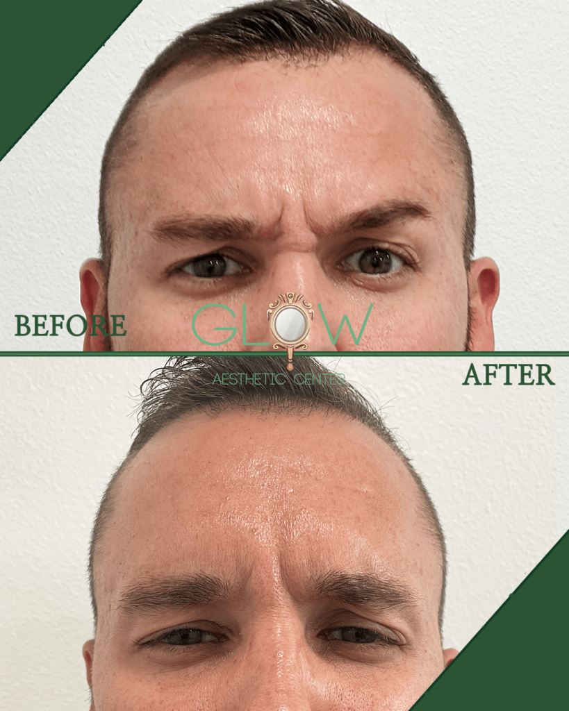 Before and after comparison of a male client showing significant improvement in forehead appearance after treatment at Glow Aesthetic Center, highlighting reduced wrinkles and smoother skin texture.