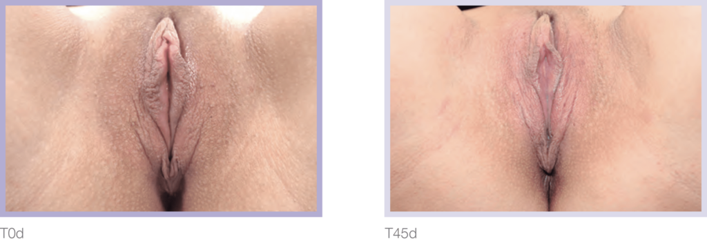 Medical images comparing two types of vulvar anatomy labeled as T0d and T45d, highlighting differences in appearance and structure for educational purposes.