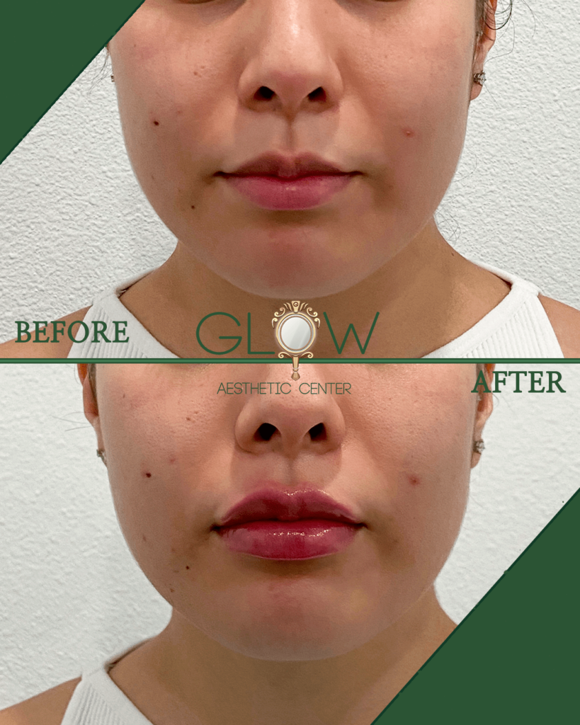 Before and after comparison of a lip enhancement treatment at Glow Aesthetic Center, showcasing improved lip fullness and smoothness. The image highlights noticeable changes in lip shape and overall facial appearance.