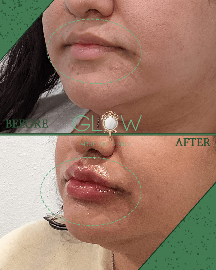 Before and after image showcasing lip enhancement results at Glow Aesthetic Center, highlighting improved lip volume and smoothness. The 'before' section displays natural lips with minor imperfections, while the 'after' section reveals fuller, glossier lips, demonstrating effective aesthetic treatment.