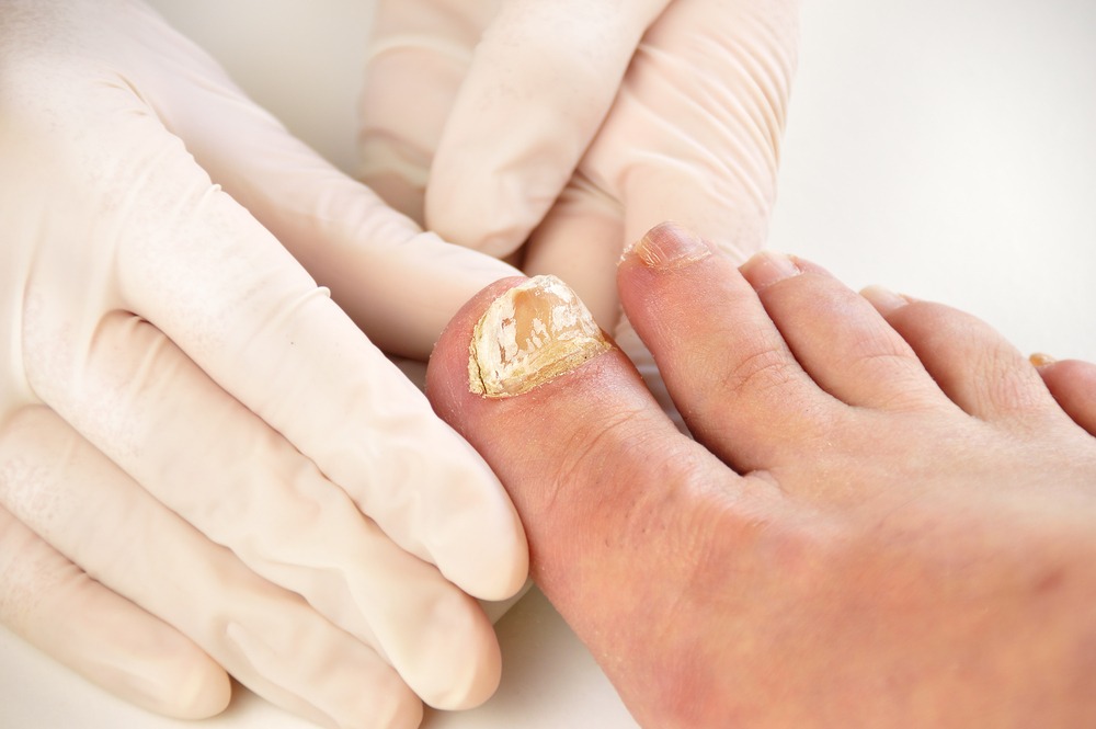 How To Get Rid Of Nail Fungus
