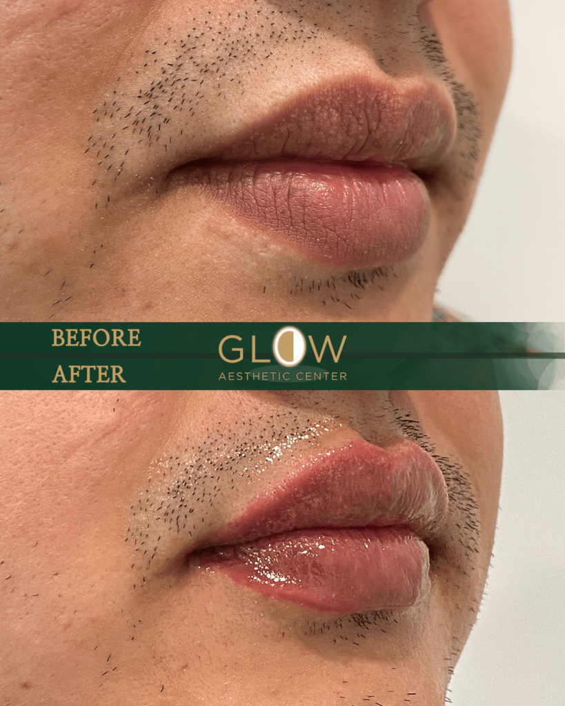 Before and after image showcasing lip enhancement results at Glow Aesthetic Center, highlighting improved lip volume and definition in a male client.