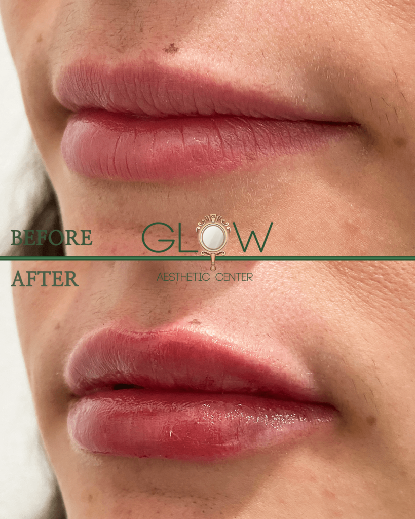 Before and after image showcasing lip enhancement results at Glow Aesthetic Center, highlighting fuller and more defined lips post-treatment.