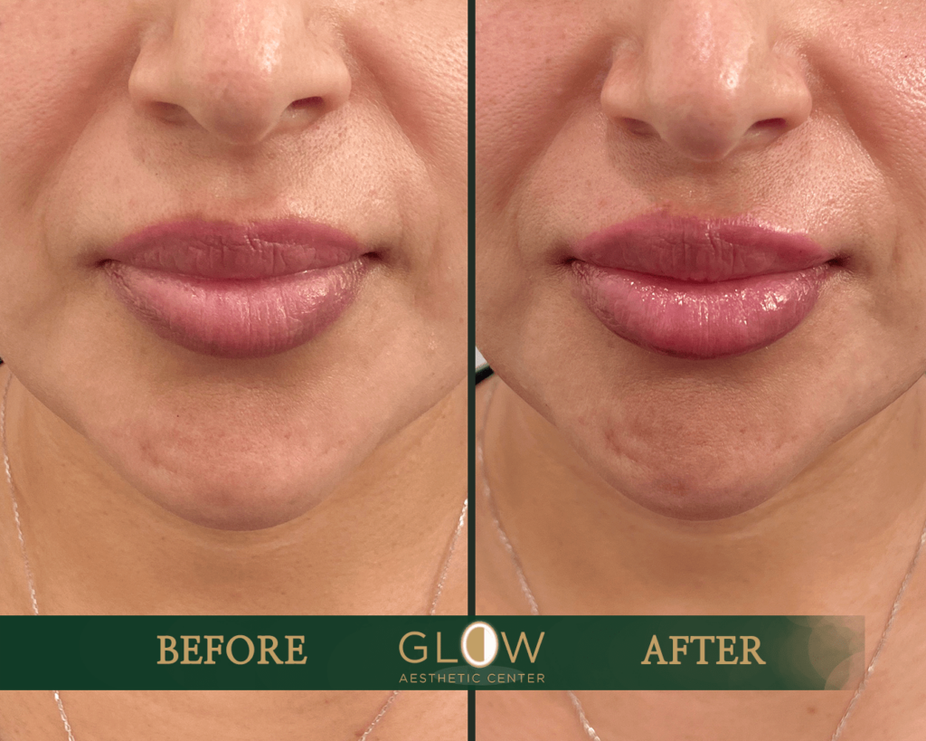 Before and after photo showcasing lip enhancement results at Glow Aesthetic Center, highlighting improved lip volume and smoothness. The left side displays the initial appearance, while the right side shows the enhanced, fuller lips.