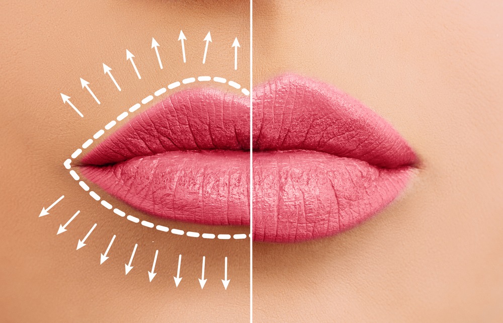 Different Types Of Cosmetic Lip Treatments and Enhancements