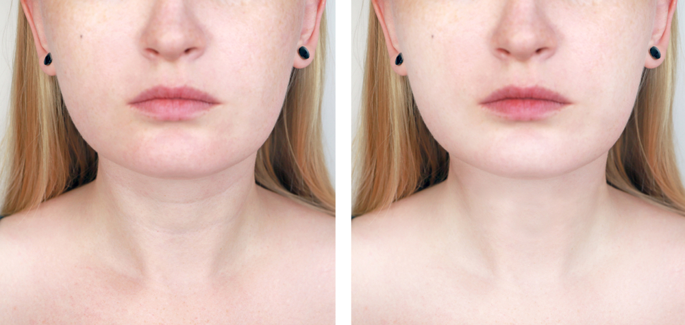 Image comparison of a woman’s face before and after a skincare treatment, highlighting changes in skin texture and tone. The left side shows the original appearance, while the right side displays improvements, emphasizing a smoother and more even complexion.