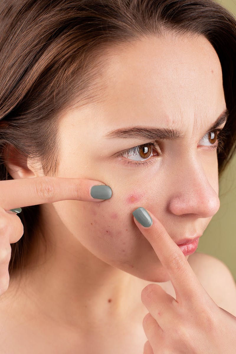 Which Celebs Have Struggled With Acne & How They Banished Their Pimples