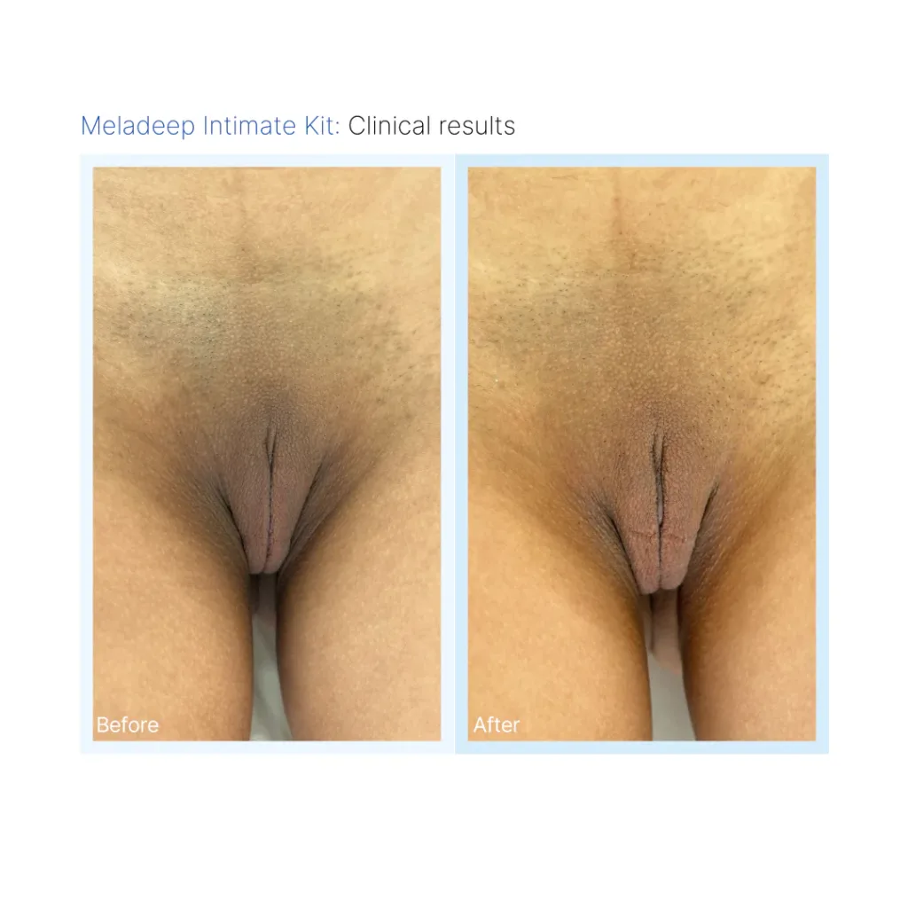 Before and after images showcasing the clinical results of the Meladeep Intimate Kit, highlighting improvements in skin tone and texture in the intimate area.